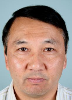 After Hair Transplant&nbsp;Front